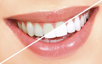 blanquiamiento dental, dientes blancos, dientes perfectos